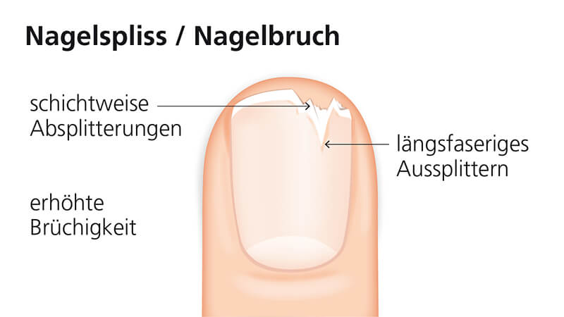 Nagelspliss/Nagelbruch Illustration