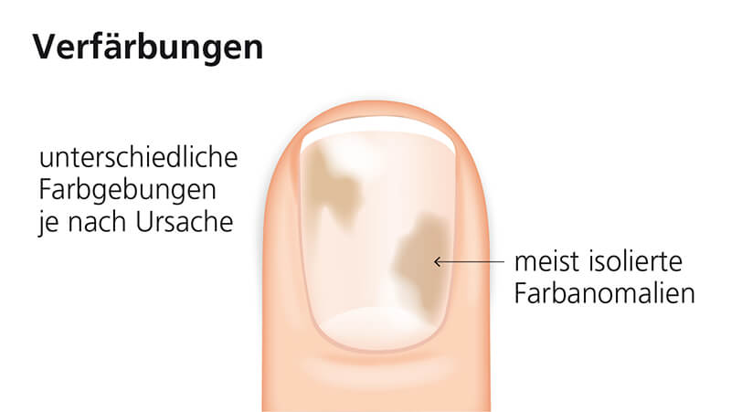 Illustration zu Nagelverfärbungen